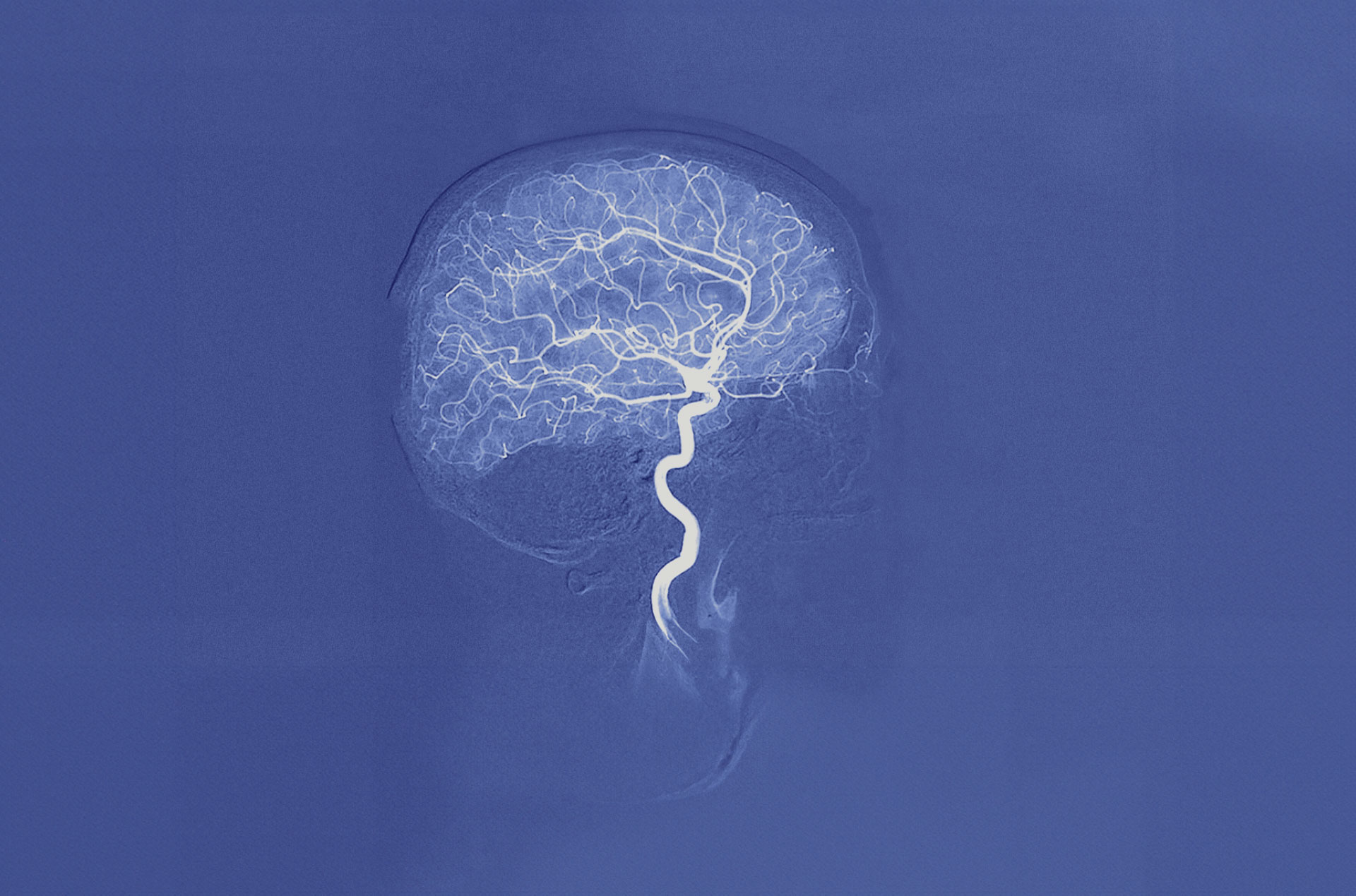 Neurocirugía endovascular